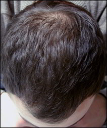 alopecie apres traitement