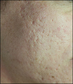 cause of acne vulgaris #10