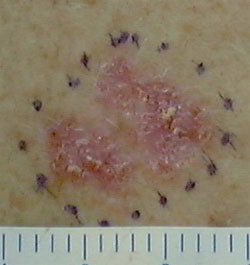 cancer de la peau
