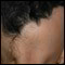 alopecie