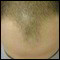 hair loss