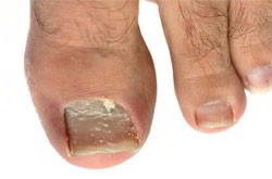 mycose des ongles