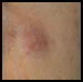 nodule