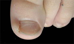 ongles incarn�s