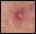 papule