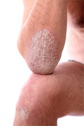 psoriasis