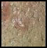 pustule