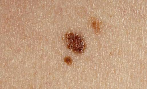 Peau Du Gland Seche Qui Pèle Abimelec