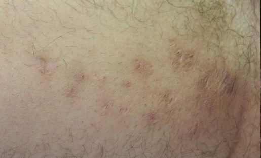 La maladie de la peau le psoriasis