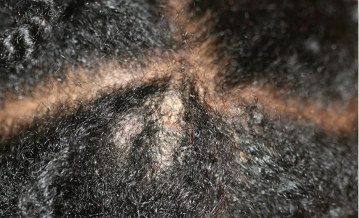 La photo du psoriasis aux places intimes
