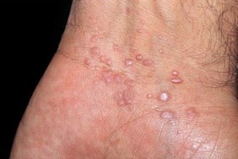 scabies rash on hands #10