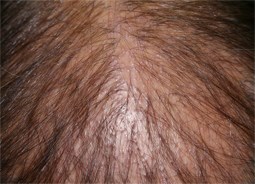 Lichen plan pilaire du sommet du crâne : alopécie diffuse & petites croûtes à la racine des cheveux