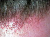 Frontal fibrosing alopecia