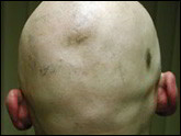 Alopecia areata totalis pattern