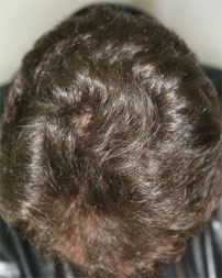 alopecie traitement