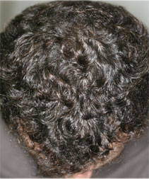 alopecie