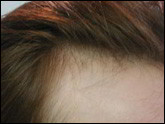 Female-pattern baldness 