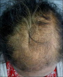alopecie femme avant traitement