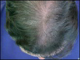 Female-pattern baldness 