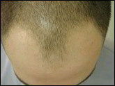 Male Pattern hair Loss