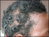 Alopecia areata totalis pattern