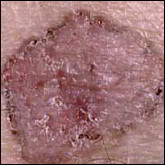 Carcinomes basocellulaires et cancer de la peau | Dr Abimelec