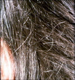 lente-cheveux