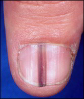 melanome ongle