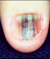 melanome ongle