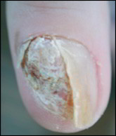 melanome ongle