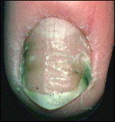 mycose des ongle (périonyxis chronique)