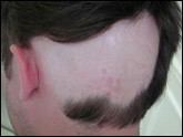 Alopecia areata-ophiasis pattern