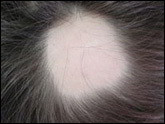 Alopecia areata-patchy pattern