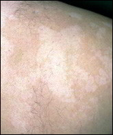 Pityriasis Versicolor