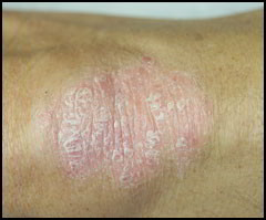 Psoriasis et traitements du psoriasis | Dr Abimelec