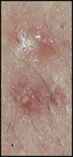 pustule acné