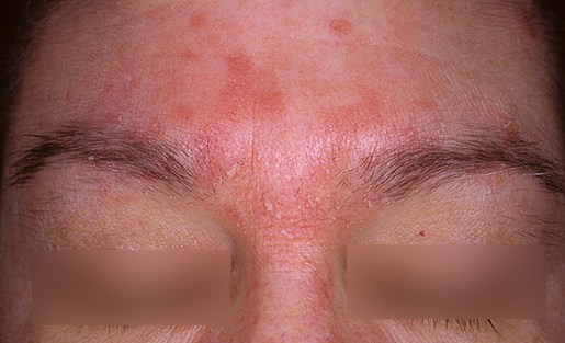 Pityriasis Rosé De Gibert Traitement Naturel Abimelec » La peau"