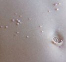 Molluscum contagiosum