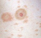 pityriasis rosé de gibert