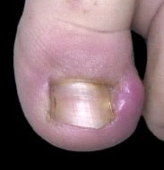 Ongle incarné chronique du gros orteil