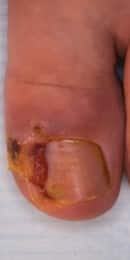 Technique du bandage pour le traitement podologique de l'ongle incarné du gros orteil