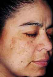 Melasma - Taches sur le visage (chloasma) | Dr Abimelec