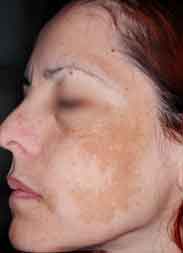 Melasma - Taches sur le visage (chloasma) | Dr Abimelec