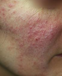Rosacée, couperose, acné rosacée et traitements | Dr Abimelec - Paris