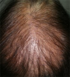 Lichen plan pilaire du sommet du crâne : alopécie diffuse & petites croûtes à la racine des cheveux