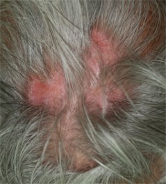 Lichen plan pilaire : alopécie en plaques & petites croûtes à la racine des cheveux