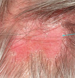 Lichen plan pilaire : alopécie en plaques & petites croûtes à la racine des cheveux